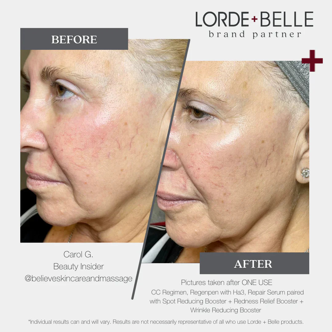 10 Expert Tips to Reduce Facial Redness and Glow - Lor – REALHER