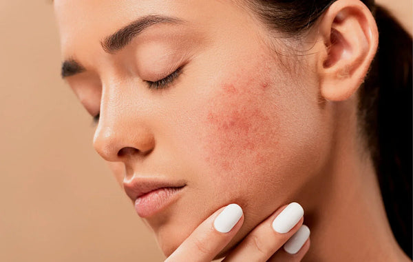 Is my skin purging or breaking out? Let’s figure it out together